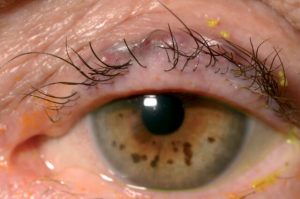 Trichiasis
Ingrown Eyelashes